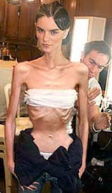 anorexia.jpg