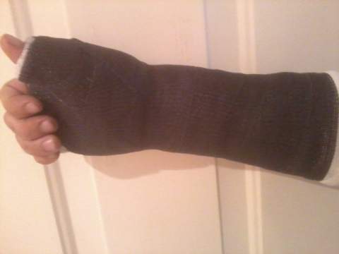 Broken wrist.jpg