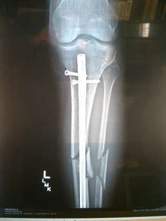 brokenleg-01.JPG