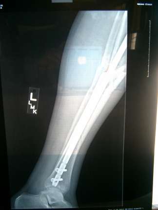 brokenleg-02.JPG