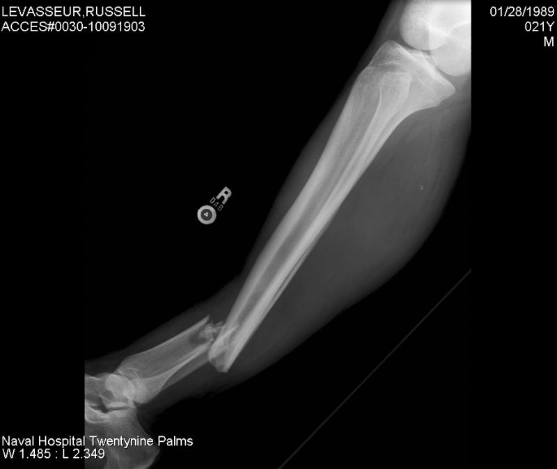 brokentibia1.jpg