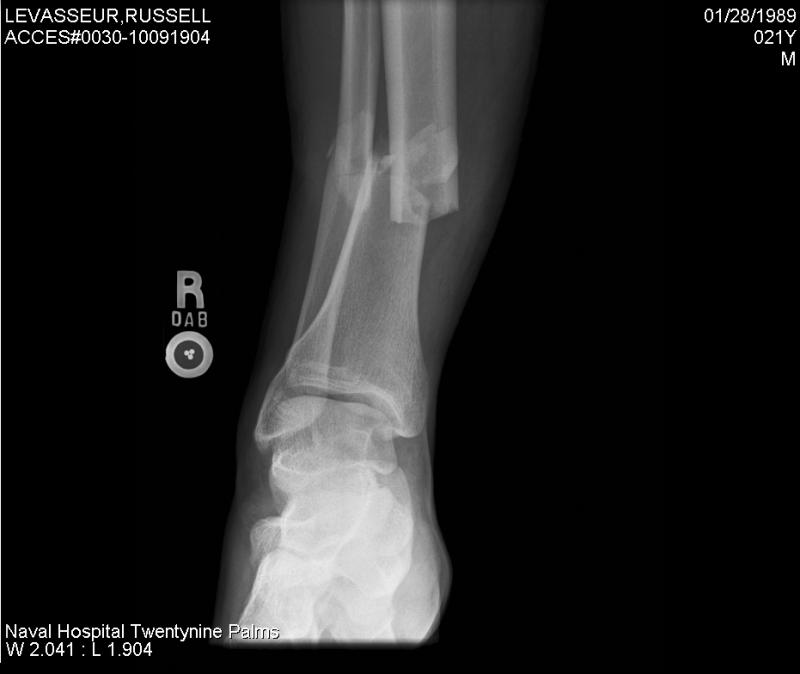 brokentibia3.jpg