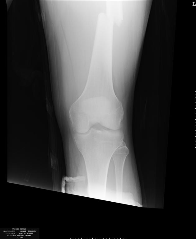 femur2 (Medium).jpg