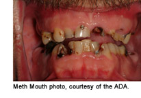 meth_mouth_1.jpg