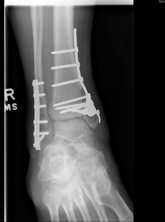 My Broken Ankle - 2.jpg