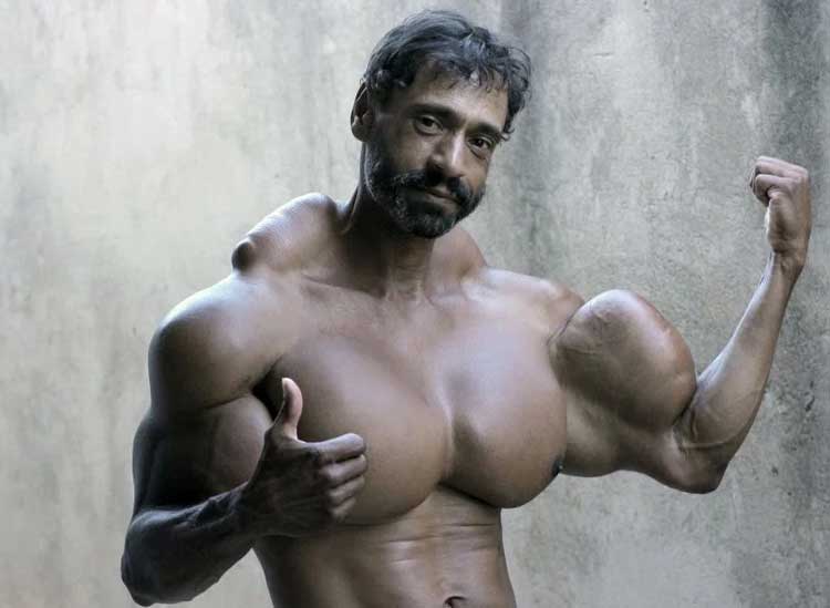 synthol-abuse-pecs-6.jpg